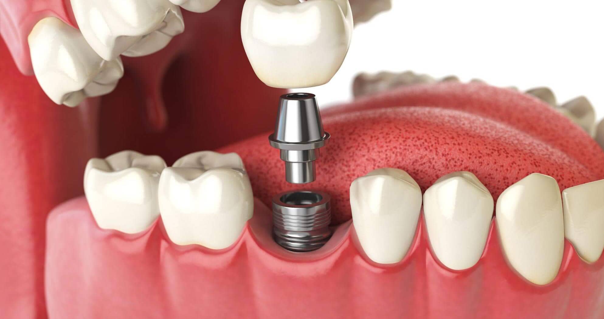 Implantes Dentários: Restaurando Sorrisos em Joinville