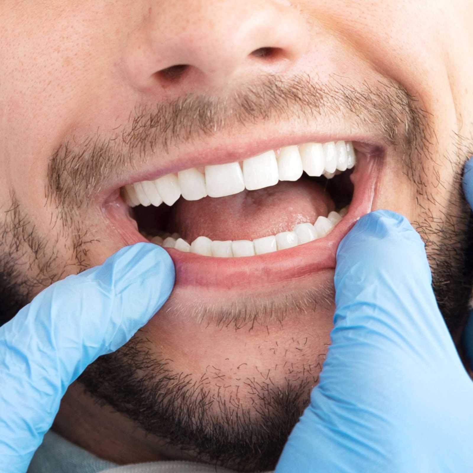 Recontorno e Facetas em Resina